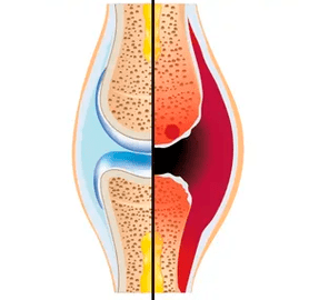 D'Struktur vun engem gesonden a verschwonne Gelenk mat der Bezeechnung vum Knorpelgewebe a Synovialflëssegkeet
