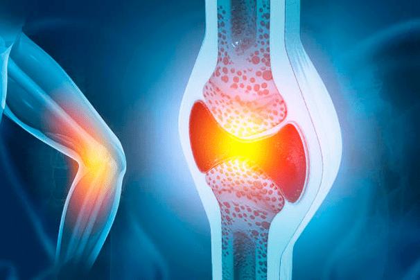 Präventioun vu Gelenkkrankheeten